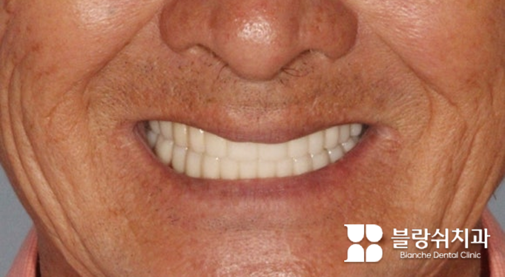 임플란트 시술 후 행복한 웃음을 짓는 60대 남성