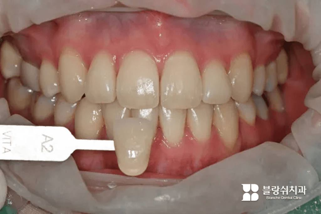 1.치아 미백 전 색상 측정을 위한 비타 쉐이드 가이드 비교 장면