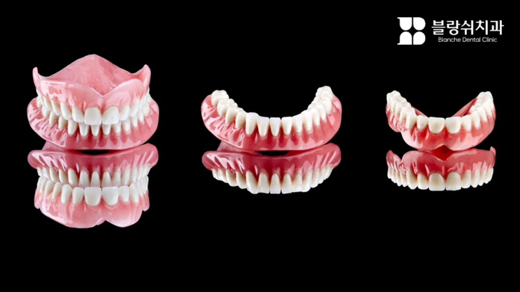 디지털 풀아치 임플란트란 무엇인가요?