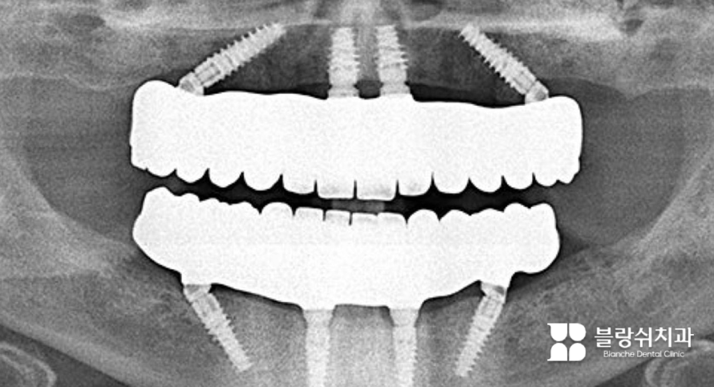 디지털 풀아치 임플란트의 주요 장점