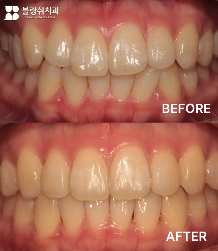 20대 앞니 겹침, 비발치 인비절라인으로 자연스럽게 교정한 사례
