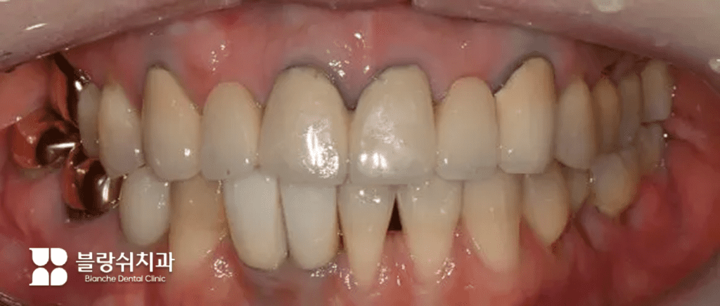 3.미백 치료 전 치아 전반에 변색이 관찰되는 구강 내 정면 사진
