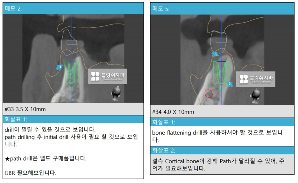 네비게이션 임플란트의 장점, 3D CT