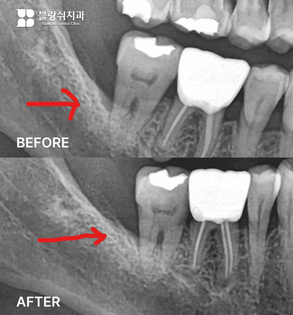 7.치조골 소실로 인해 흔들림이 발생한 치아의 엑스레이 소견