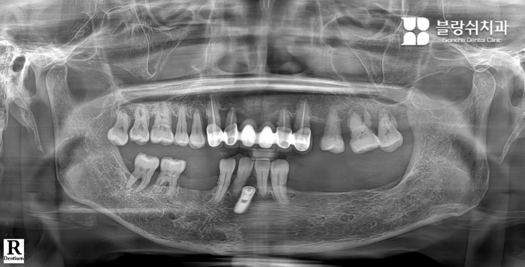Case 2. 틀니 불편함으로 대인관계를 피하던 60대 여성