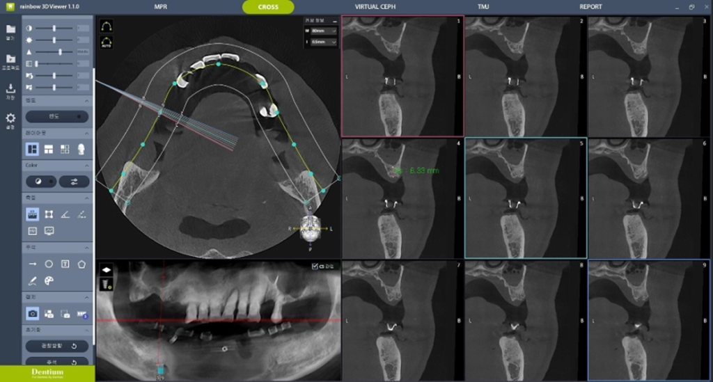 충치 치료 전 검사(X-ray·CT·구강스캔 등)로 진단하는 과정 이미지