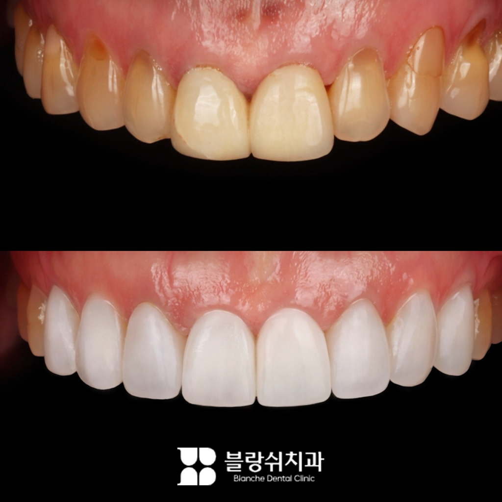 누런이 무삭제 라미네이터 시술