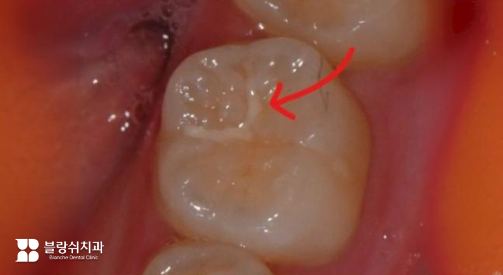 초기 충치에 시행하는 레진 치료 예시 이미지