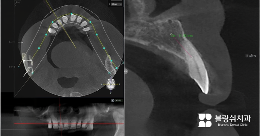3D CT 데이터 분석을 통해 치조골의 폭과 밀도를 확인하고 무절개임플란트 식립 경로를 정밀하게 설계하는 과정