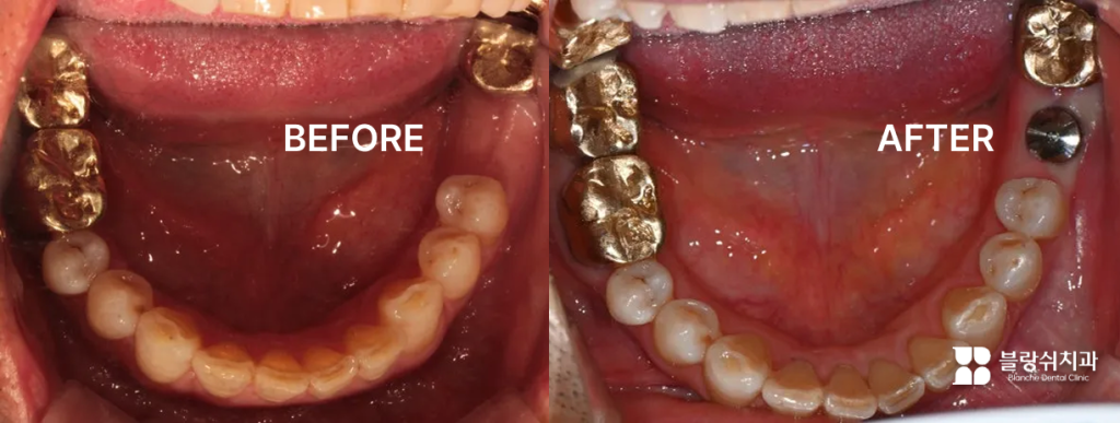 어금니 상실 부위에 무절개임플란트 시술을 진행하여 잇몸 손상을 최소화하며 치아 기능을 회복한 실제 구강 내 전후 비교 모습
