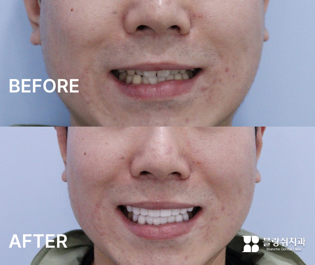 수면 치료 치과에서 앞니 라미네이트 시술을 진행하기 전의 불규칙한 치아와 시술 후 고르고 하얗게 변한 미소의 전후 비교