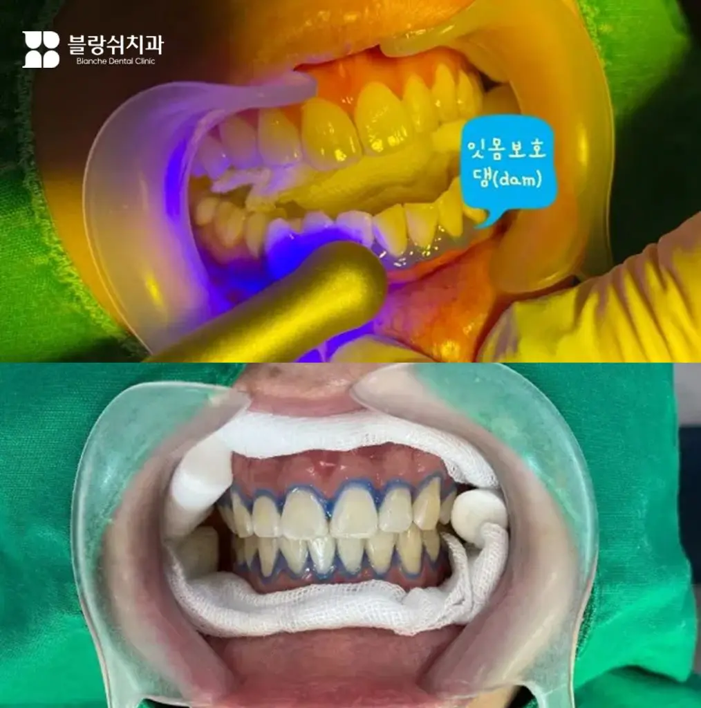 2.치아미백 시술 전 잇몸 보호댐(dam) 적용 과정, 잇몸 손상 방지를 위한 보호 단계