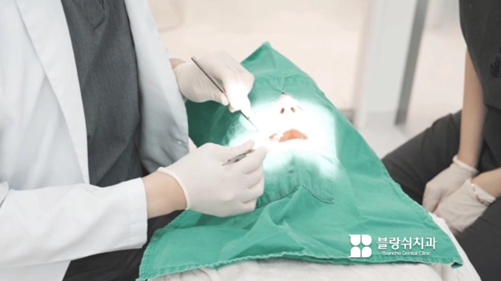 충치가 신경까지 진행됐을 때 시행하는 신경치료(근관치료) 예시 이미지