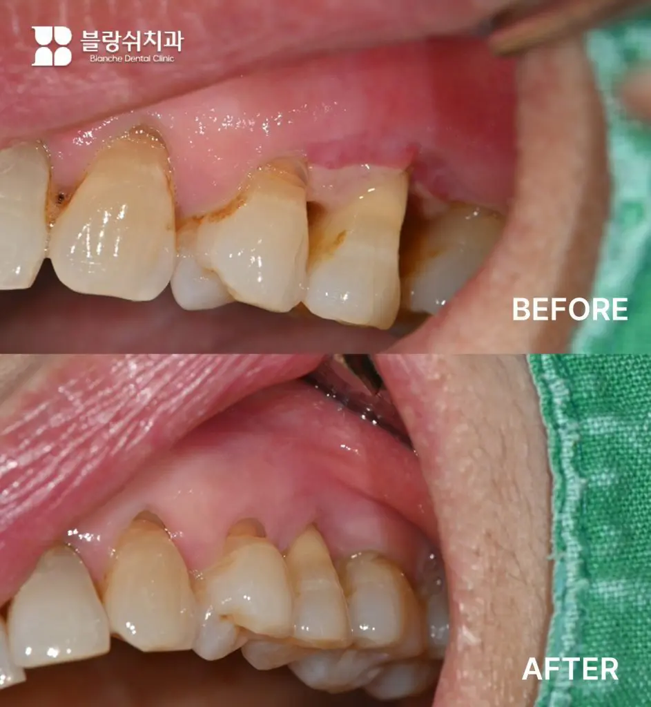 5.앞니 잇몸 퇴축과 치주 염증으로 발치가 고민되는 초기 상태 구강 사진