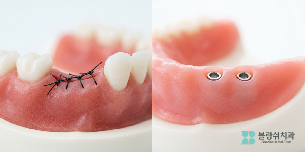잇몸을 절개하고 봉합하는 기존 방식과 작은 홈을 통해 식립하여 통증과 부기를 줄이는 무절개임플란트 방식의 외관 차이 비교