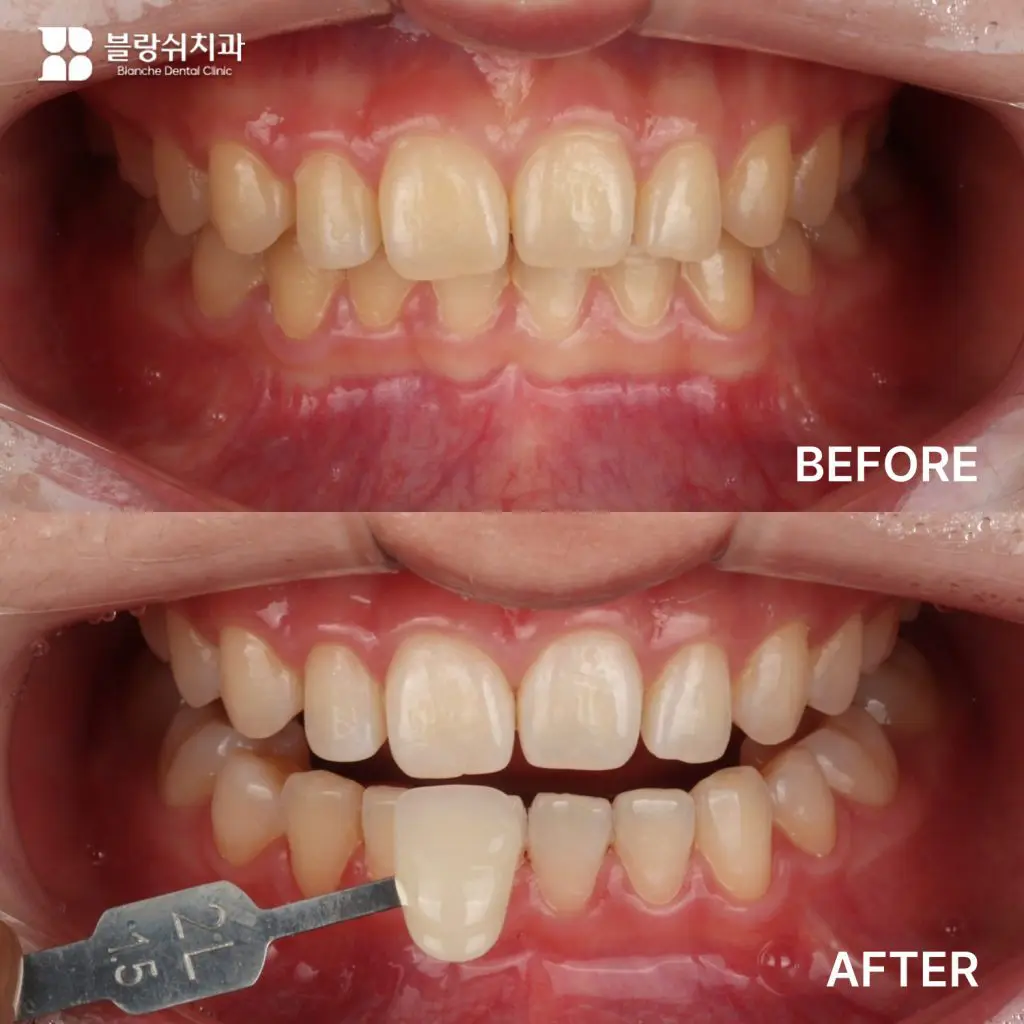 커피 착색으로 고민하던 30대, 치아미백 사례