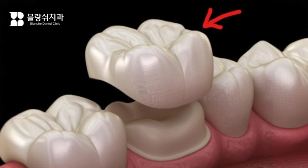 신경치료 후 치아를 보호하는 크라운 치료 예시 이미지