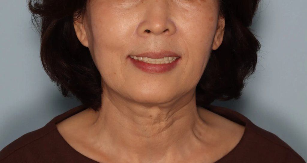 풀아치임플란트 후 자신감을 회복한 분