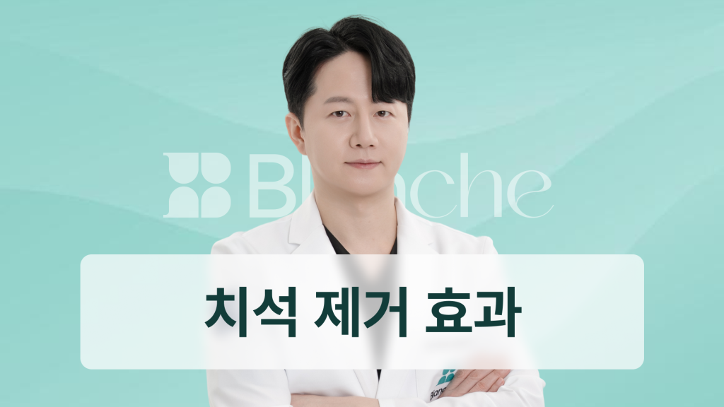 스케일링 치석 한 번으로 끝? 치석 제거 효과와 예방까지 완벽 정리