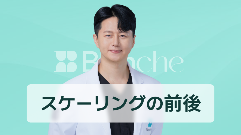【韓国歯科】スケーリング前後の変化や痛みまで完璧に整理 歯が白くなる本当の理由を公開