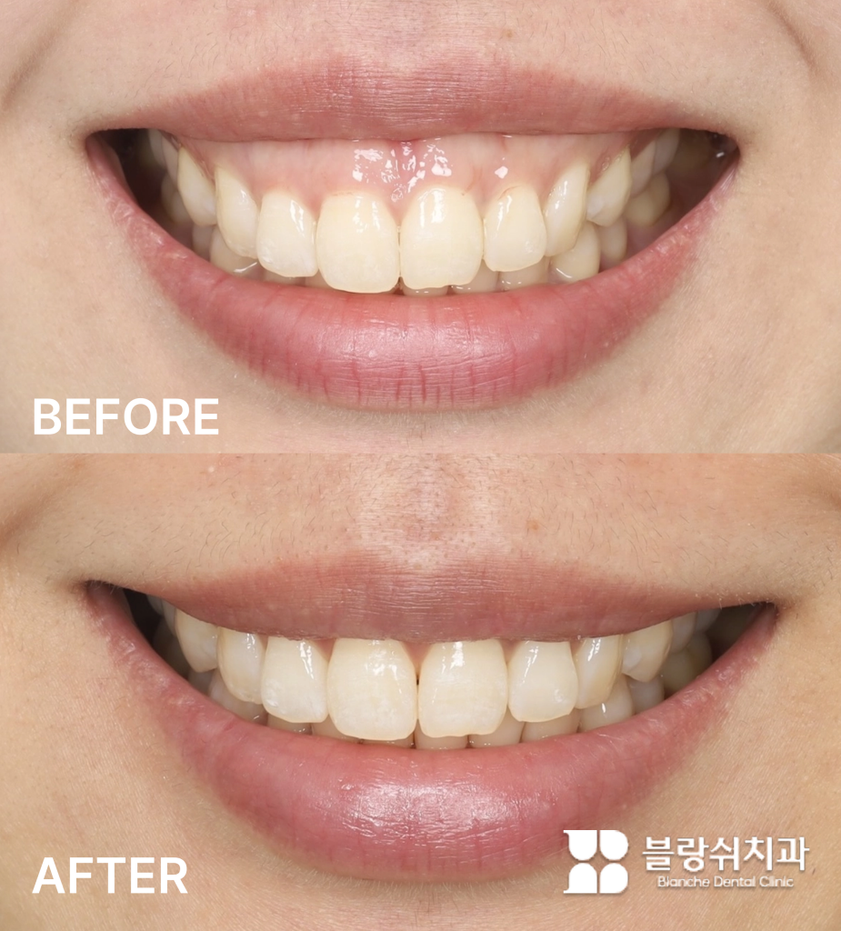 거미스마일 해결을 위해 구강전정술을 진행한 시술 전후 비교