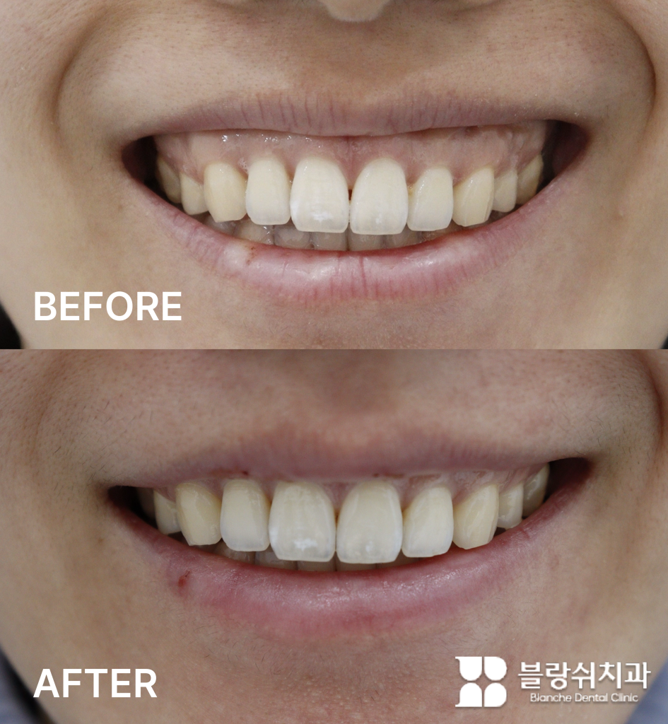 거미스마일 완화를 위한 1차 잇몸성형과 2차 보톡스 시술 비교