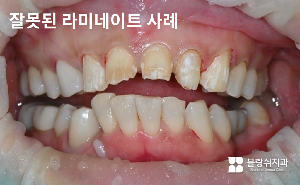 치아가 과도하게 삭제되어 라미네이트 부작용이 심각한 상태