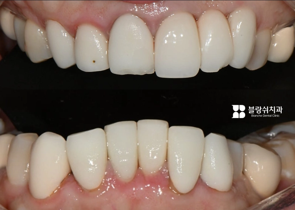 라미네이트 시술 부작용 사례: 맹출 진행 중