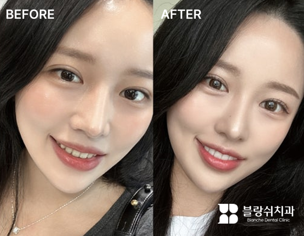 치아미백 시술 전후 밝기 차이가 뚜렷한 여성의 얼굴 비교
