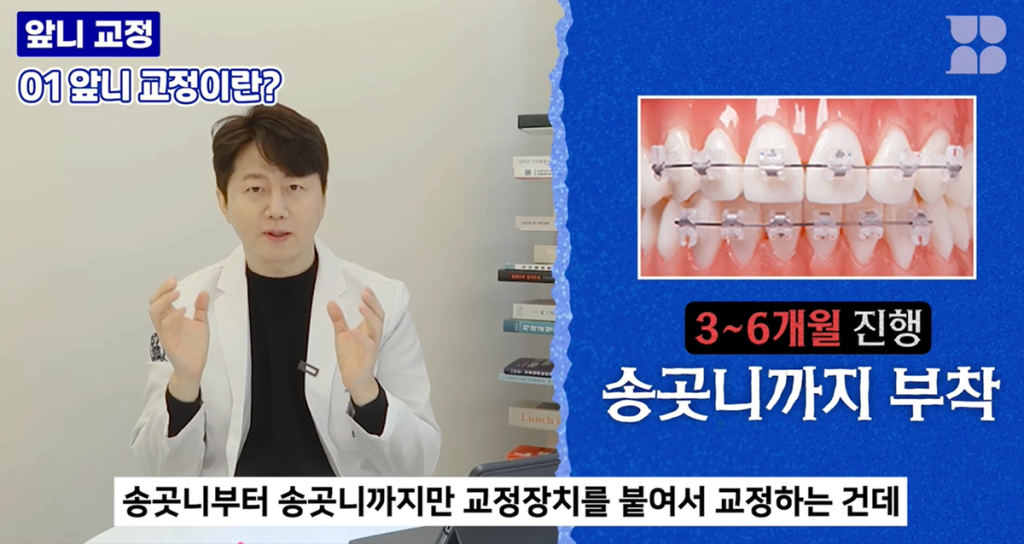 토끼이빨 앞니 부분교정(앞니 6~8개) 치료를 설명하는 이미지