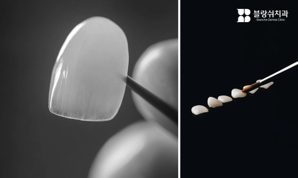 라미네이트로 치아 모양·색상·배열을 개선하는 설명 이미지