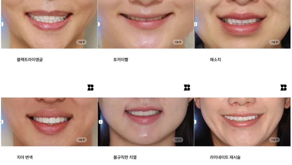블랑쉬치과의 다양한 앞니 라미네이트 시술 케이스