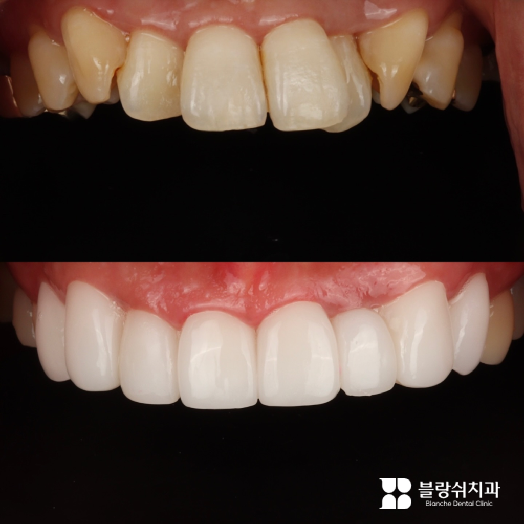 라미네이트 부작용 걱정 없는 블랑쉬치과 시술 전후 비교