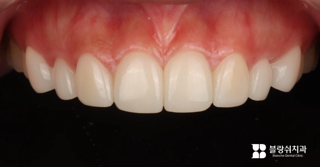 자연스럽고 투명한 앞니 라미네이트 시술 후 모습