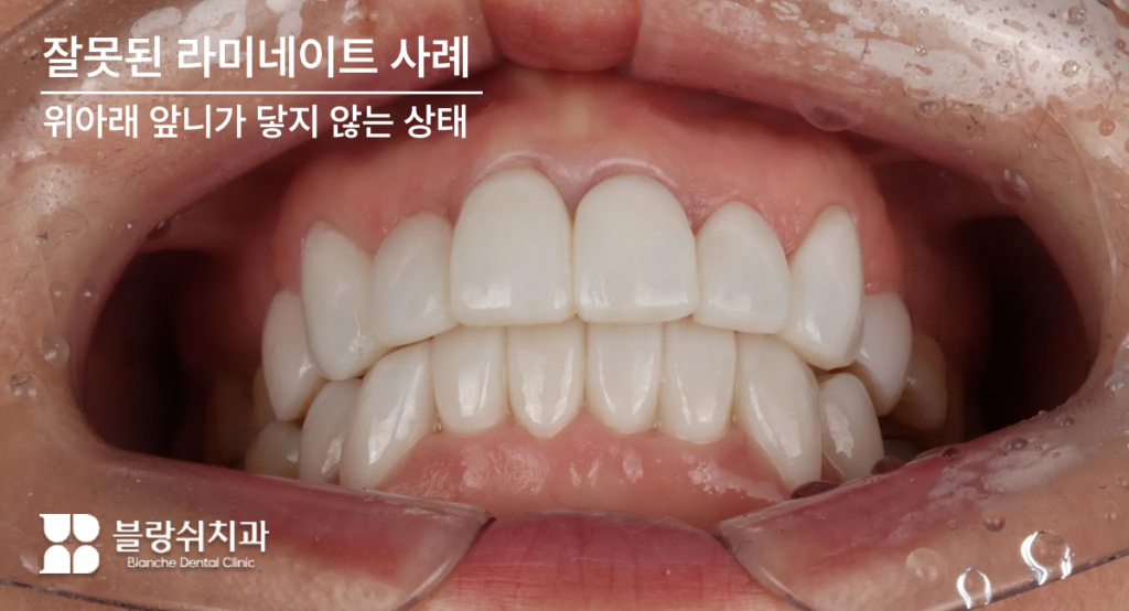 위아래 앞니가 닿지 않는 부정교합 라미네이트 부작용