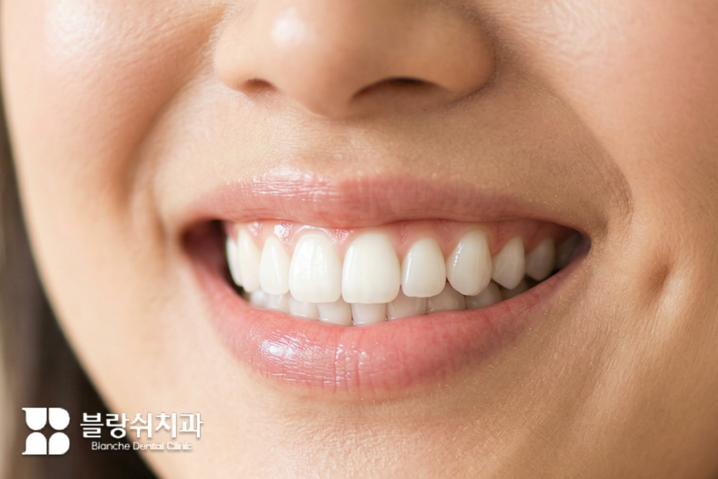 치아미백 후 자신감 있게 미소 짓는 깨끗하고 하얀 치아