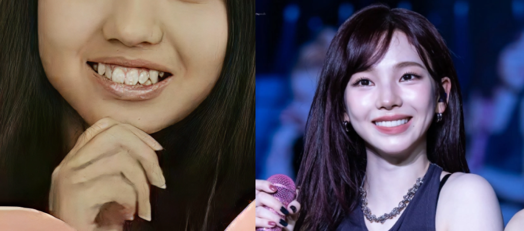 라미네이트 시술 전과 후의 치아 대칭을 비교한 에스파 카리나