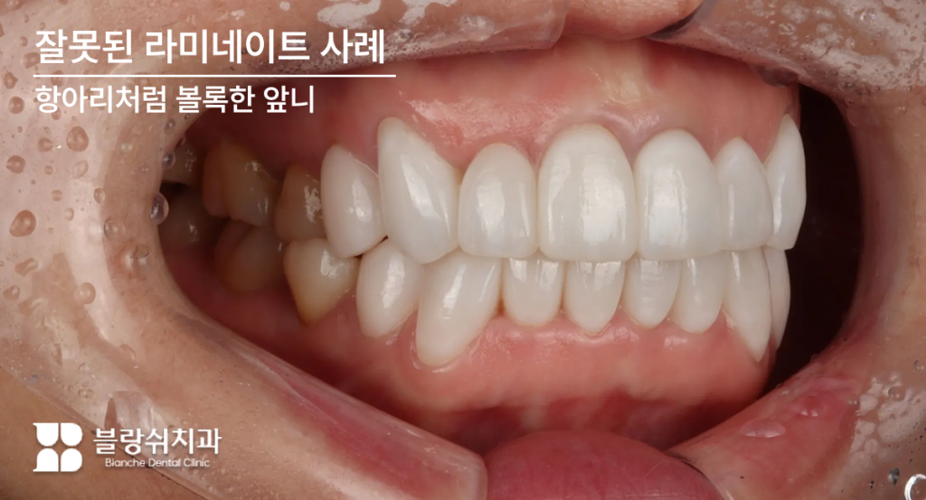 항아리처럼 볼록하게 돌출된 라미네이트 부작용 사례
