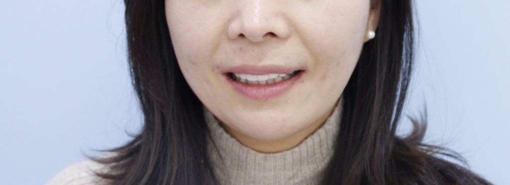 라미네이트, 미백보다 형태 개선에 더 적합한 시술입니다