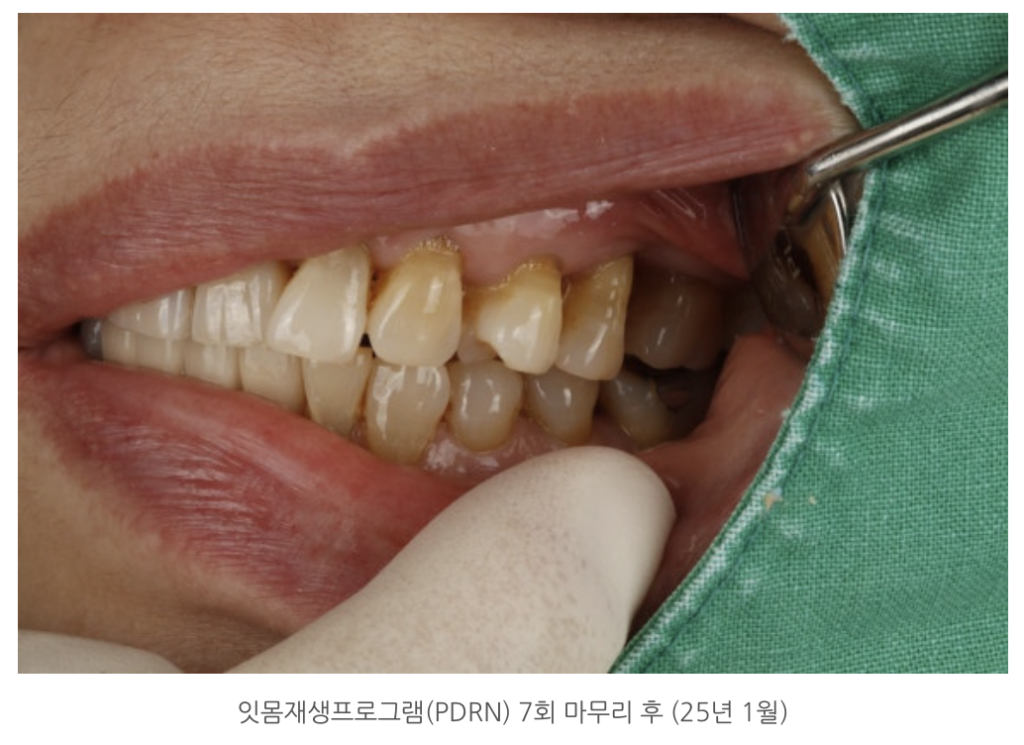 잇몸재생프로그램(PDRN) 7회 마무리 후 (25년 1월)