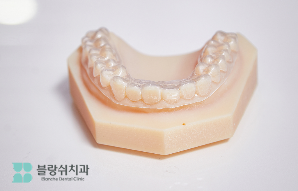 30대 40대 치아교정용 인비절라인 투명 장치가 장착된 치아 모형