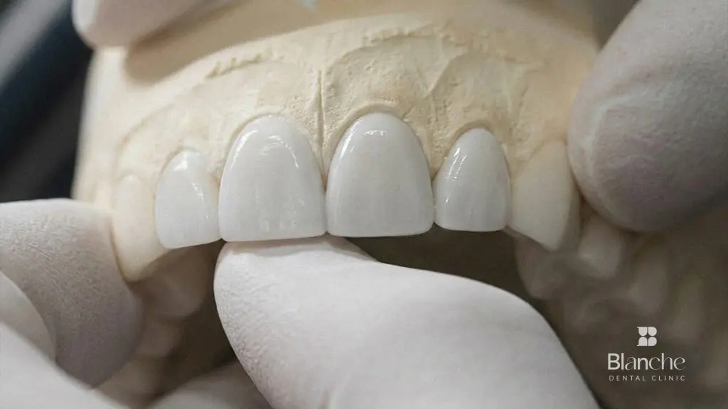 Veneers Korea cost