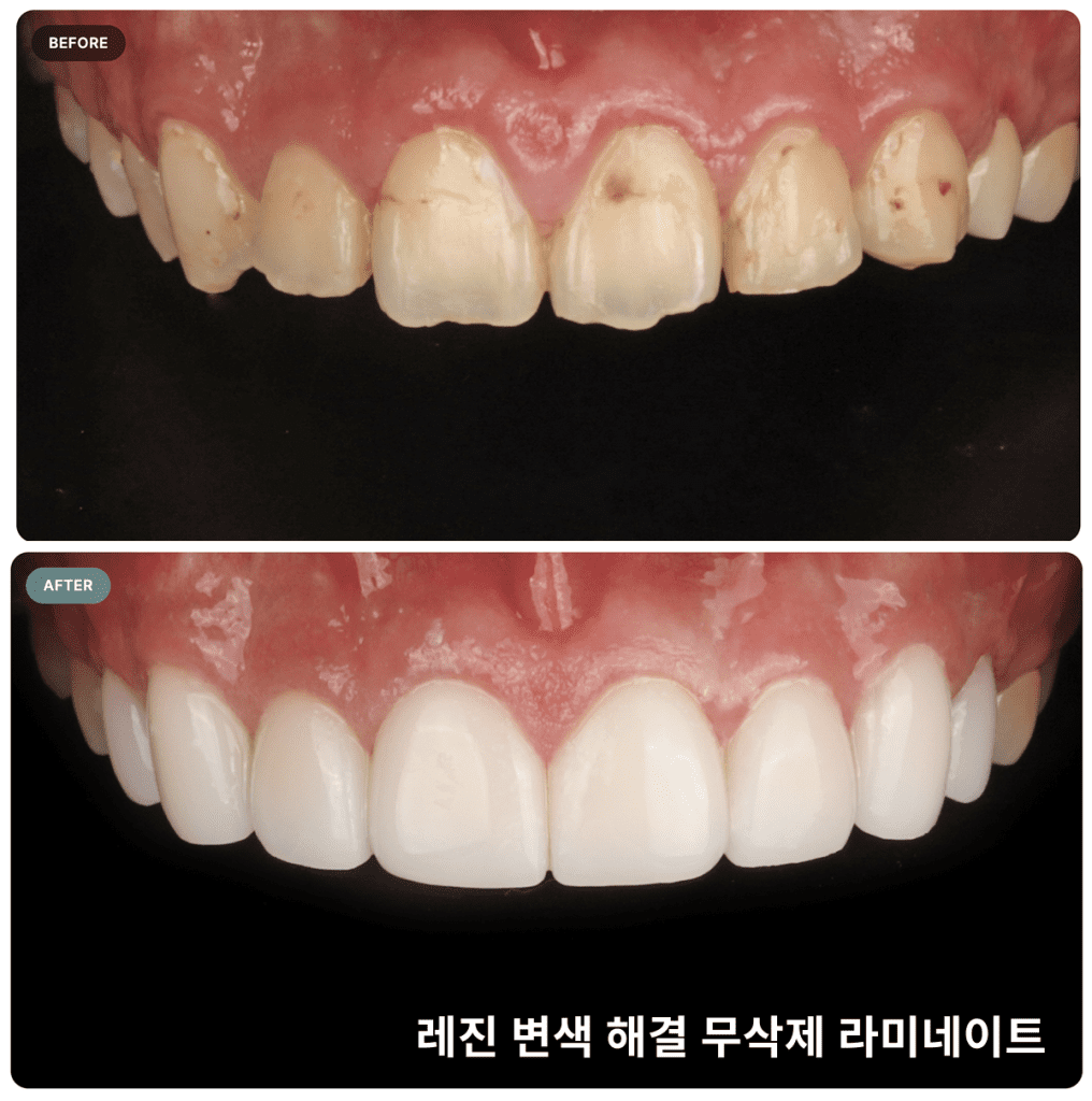 레진 변색을 무삭제 라미네이트로 해결한 시술 사례