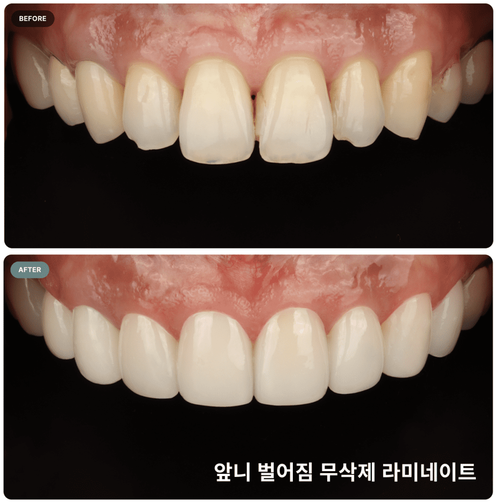 앞니 벌어짐을 무삭제 라미네이트로 해결한 시술 사례