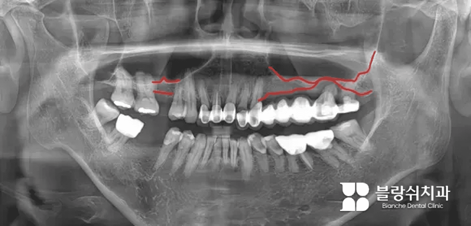 1. 상악동 거상술 전 파노라마 엑스레이에서 상악동 하방 골소실이 확인된 상태