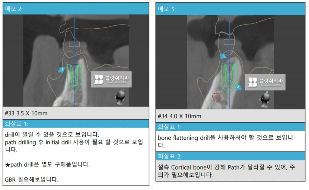 네비게이션 임플란트의 장점, 3D CT