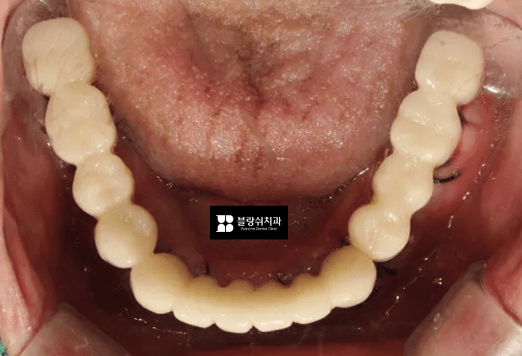 네비게이션 임플란트 후 임시치아를 낀 모습, 하악 사진