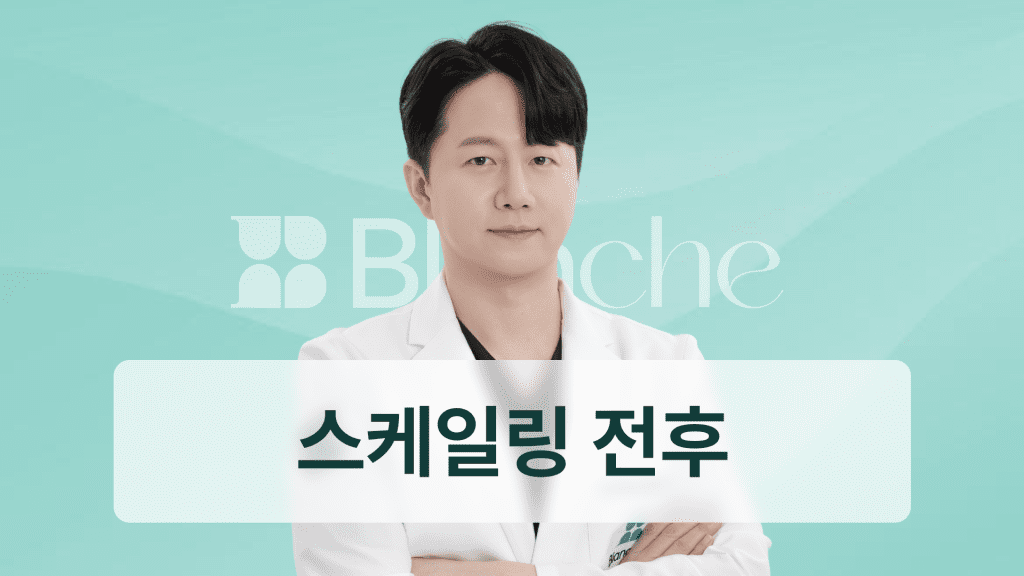 스케일링 전후 변화와 통증까지 완벽 정리 치아가 하얘지는 진짜 이유 공개