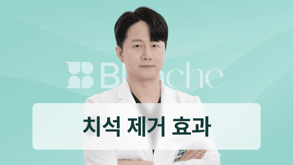 스케일링 치석 한 번으로 끝? 치석 제거 효과와 예방까지 완벽 정리