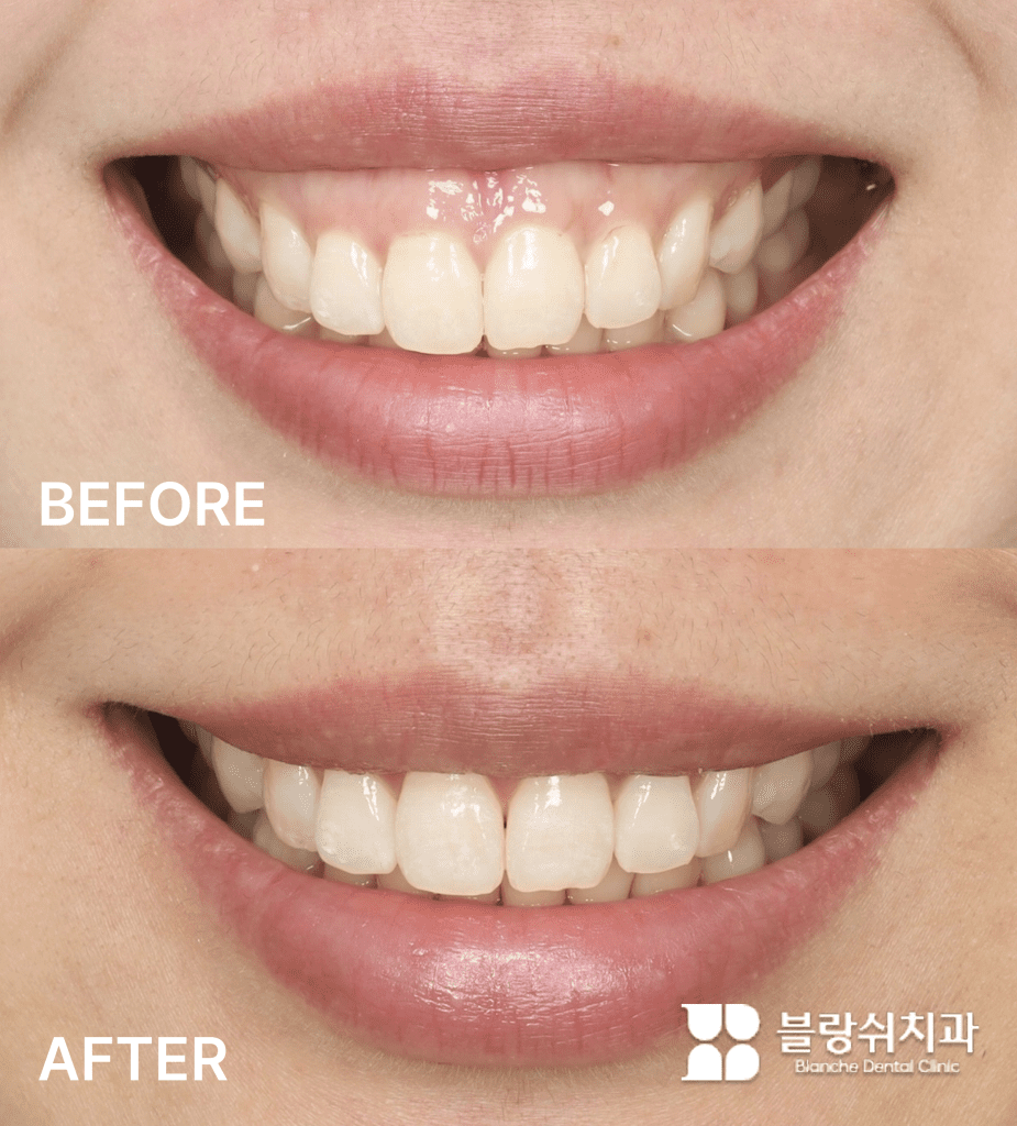 거미스마일 해결을 위해 구강전정술을 진행한 시술 전후 비교